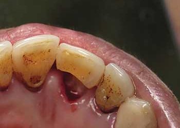 Compromised Cases – EQUIA Forte® HT – Dr. Ahmad Fayad