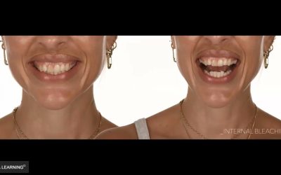 Anterior Direct Composite Restorations – The Ultimate Additive Solution