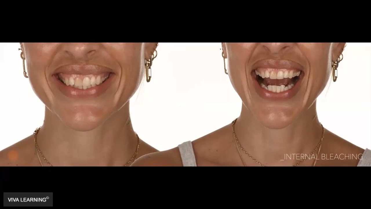 434XjQEUayk-HD Anterior Direct Composite Restorations - The Ultimate Additive Solution