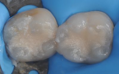 Amalgam Replacement – Compromised Case – Dr. Victor Cedillo