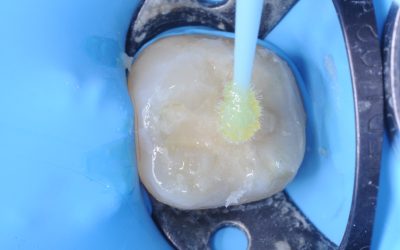 Microleakage – Compromised Cases – Dr. Victor Cedillo