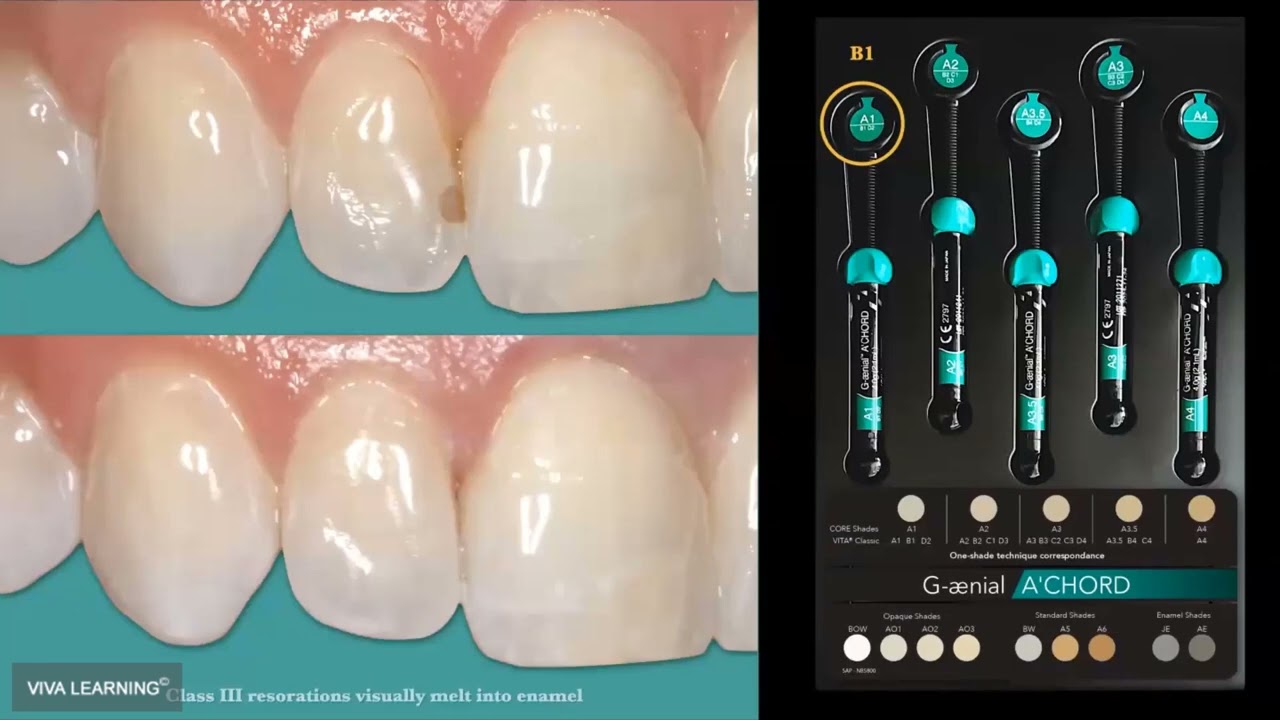 FlU5n6DHn1Q-HD Creating Imperceptible Restorations in the Aesthetic Zone using a Simplified Unishade Composite