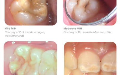 Molar Incisor Hypomineralization