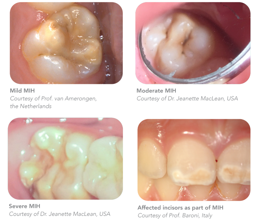 Screenshot_31 Molar Incisor Hypomineralization