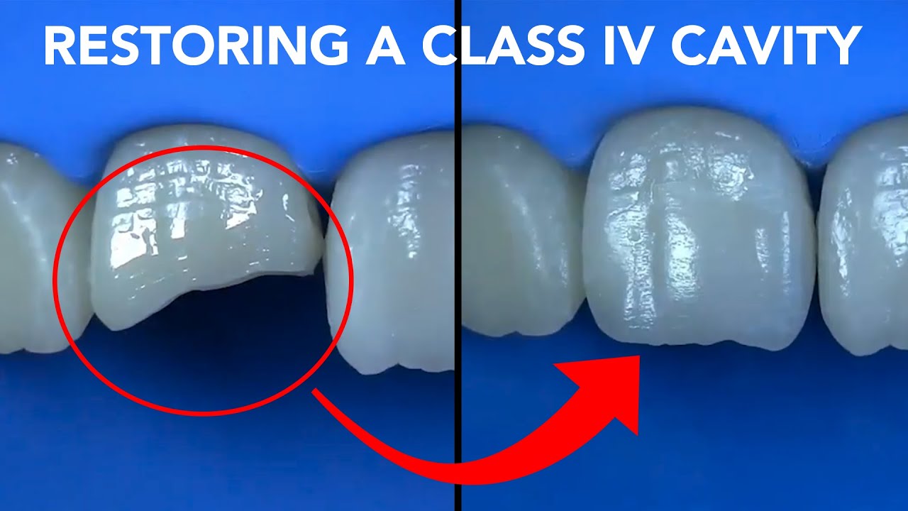 l_P1mTSIb6A-HD (1) Class IV Restoration with G-ænial™ A'CHORD