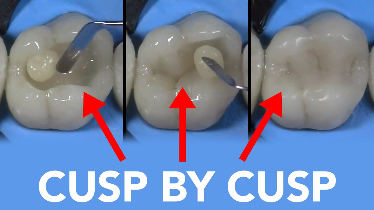 uKbweQvyNDY-HD Class II Restoration with G-ænial™ A'CHORD
