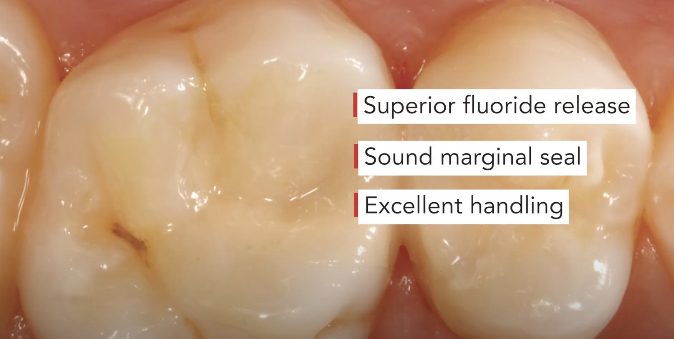 efht-vid-thumb Restorations That Cross Generations - EQUIA Forte® HT