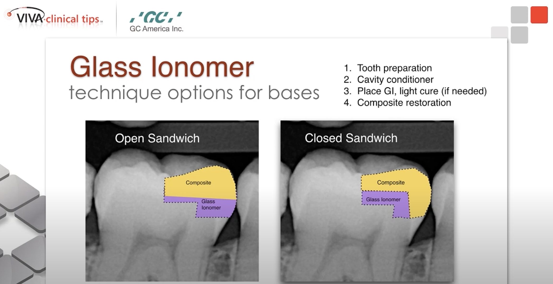 maragliano-podcast Dr. Maragliano-Muniz on Open and Closed Sandwich Techniques