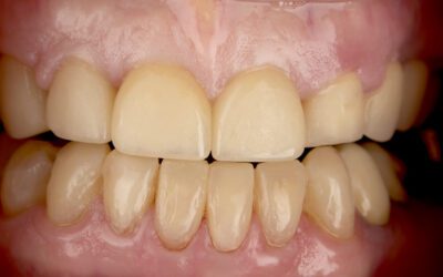 Injection Resin Technique – Dr. Douglas A. Terry